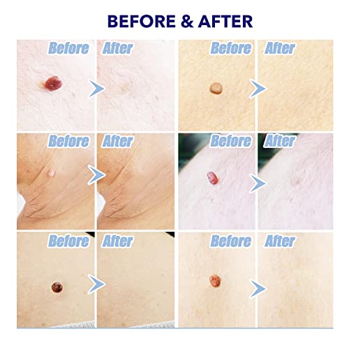 TAGRID Skin Tag Remover, Skin Tag Remover Device for Small to Medium (2mm -5m...