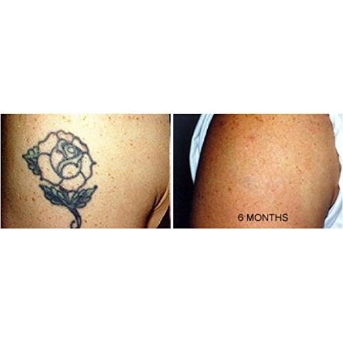 Tattoo Removal Cream Natural Fading system wrecking balm 2 week spartan perform