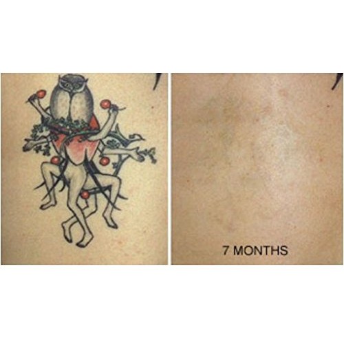 Tattoo Removal Cream Natural Fading system wrecking balm 2 week spartan perform