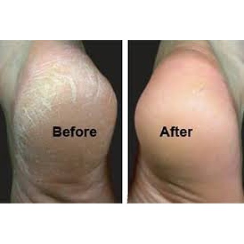 Callous Clear Foot Treatment Kit Deluxe Foot Treatments Cream Heel Balm Scrap...