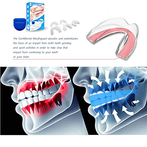 The ConfiDental - Pack of 5 Moldable Mouth Guard for Teeth Grinding Clenching...