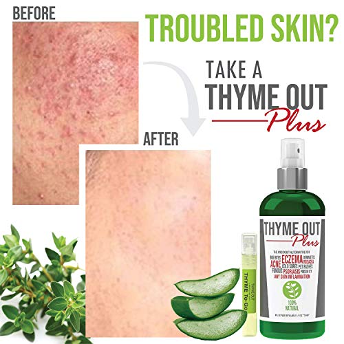 Thyme Out Plus Eczema Treatment, Psoriasis Treatment Treats Acne, Dermatitis,...