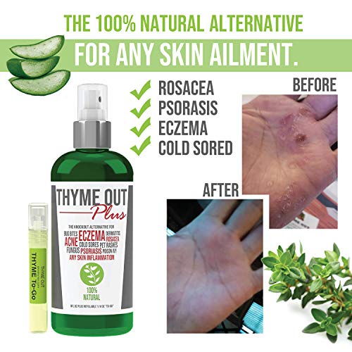 Thyme Out Plus Eczema Treatment, Psoriasis Treatment Treats Acne, Dermatitis,...