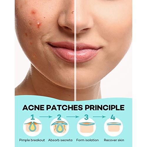 Acne Patch Pimple Patch, 4 Sizes 280 Patches Acne Absorbing Cover Patch, Hydr...