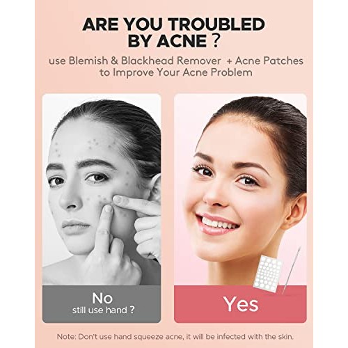 Acne Pimple Patches + Pimple Extractor, 4 Sizes 176 Patches for Zit Breakouts...