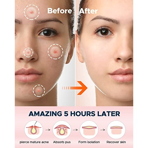 Acne Pimple Patches + Pimple Extractor, 4 Sizes 176 Patches for Zit Breakouts...