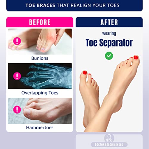 Toe Separator and Stretcher - Highly Effective Toe Straightener for Bunions, ...