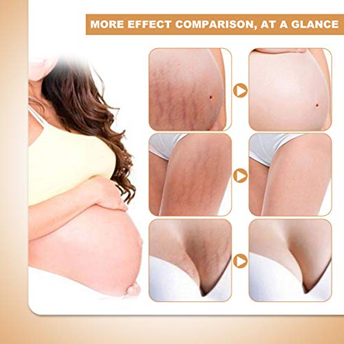 Stretch Mark Cream for Pregnancy Stretch Mark Scar Cream Postpartum Obesity P...