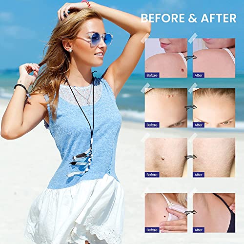 Skin Tag Remover with Advanced Formula: Safe and Effective, Convenient to Use...