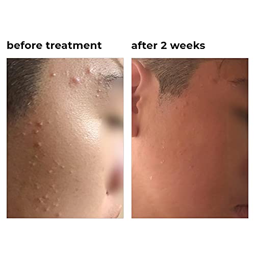 TreeActiv 3-Step Acne Treatment Kit | Charcoal Face Wash, Bentonite Pimple Sp...