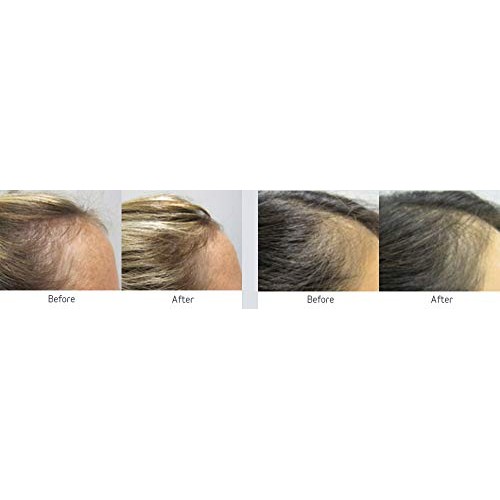 Professional Strength Hair Growth Supplement Tablets 180 Tablets & Viviscal P...