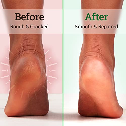 Tea Tree Oil Foot Soak with Epsom Salt & Mint, Feet Soak Helps Toenail System...