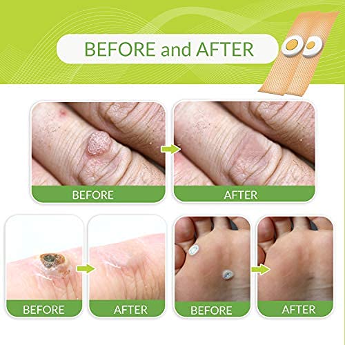 Wart Remover Pads, Remove Plantar and Common Warts | Advanced Natural Formula...