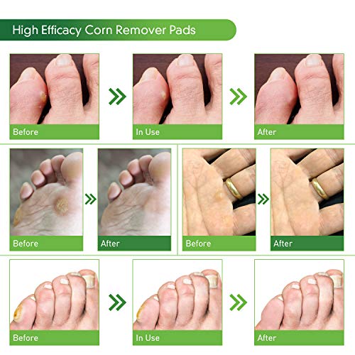 Corn Remover, 24 Corn Remover Pads, Toe Corn and Callus Removal, Corn Treatme...