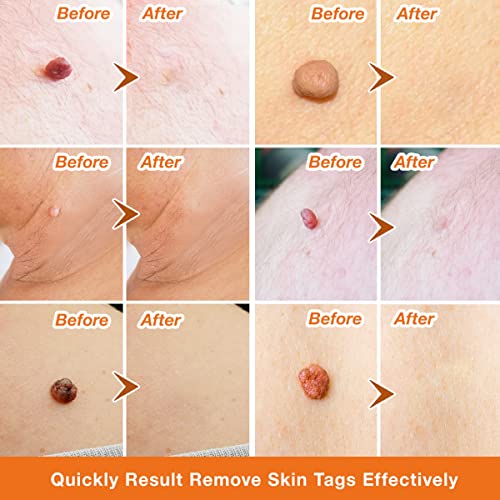 Skin Tag Remover, Standard Skin Tag Removal Kit with 36Pcs Repair Patches for...
