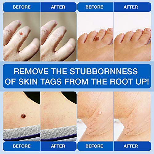 Ulensy Skin Tag Remover, All-Natural Formulation Skin Tag Removal, Fast-Actin...