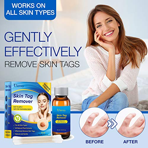 Ulensy Skin Tag Remover, All-Natural Formulation Skin Tag Removal, Fast-Actin...