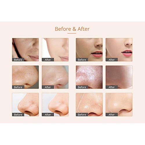 Diamond Microdermabrasion Machine By UNOISETION 3 In 1 Microdermabrasion Derm...