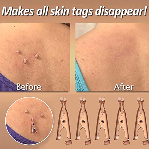 10 PCS Skin Tag Removal, Clip Copper Tag Out, Wart Remove Painless Skin Tag R...