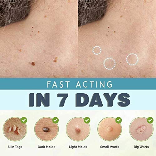 10 PCS Skin Tag Removal, Clip Copper Tag Out, Wart Remove Painless Skin Tag R...