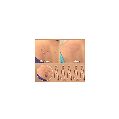 10 PCS Skin Tag Removal, Clip Copper Tag Out, Wart Remove Painless Skin Tag R...