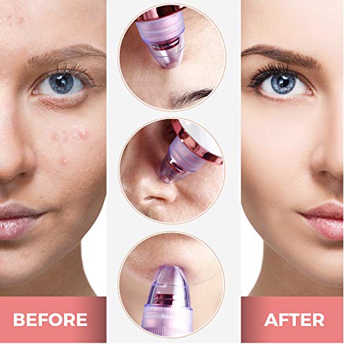 Valentine Beauty Blackhead Remover Pore Vacuum - Cleaner Rechargeable Pore Ex...