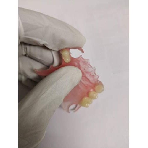 Affordable Flexible Valplast Customized Partial Denture (Pink, Valplast)