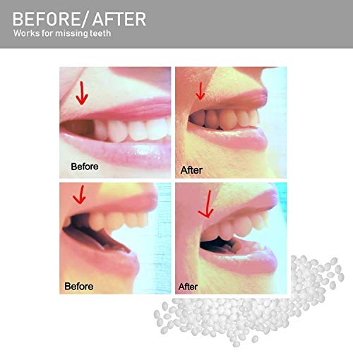Teeth Repair Kit, Temporary False Teeth, Do it Yourself Thermal Fitting Beads...