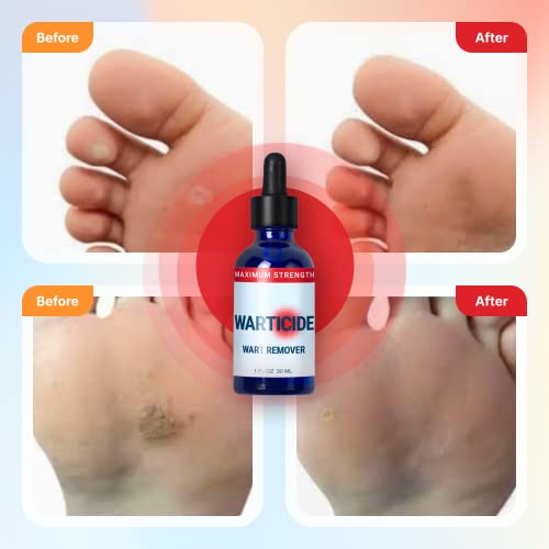 WARTICIDE Fast-Acting Wart Remover - Plantar and Genital Wart Treatment, Atta...