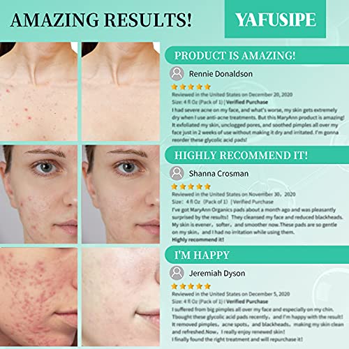 Glycolic Acid Pads 35% AHA Facial Resurfacing Pads with Vitamins B5, C & E, G...