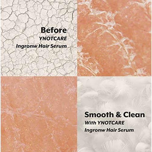 YNOTCARE Ingrown Hair Serum For Bikini Area-Prevent Ingrown Hair, Reduce Razo...