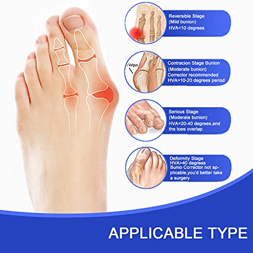 Toe Separator Bunion Corrector Bunion Splint 【2022 Updated】 Hallux Valgus B...