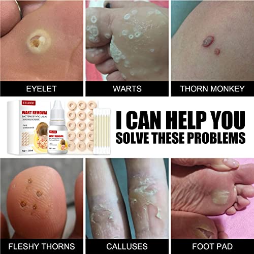 ZCXZ 2Set WartsOff Instant Blemish Removal Set, Skin Tag Remover & Wart Remov...