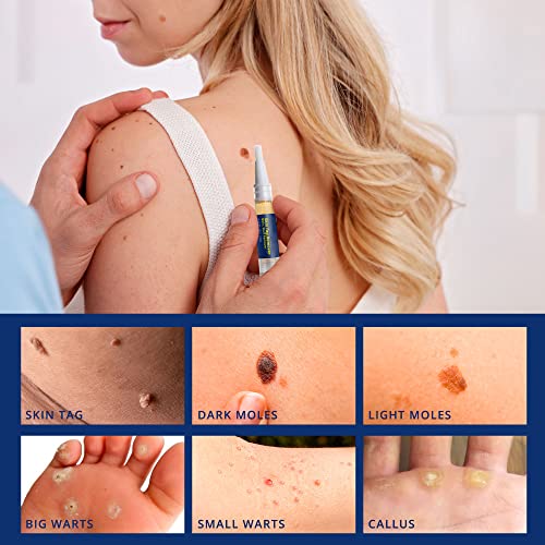 Skin Tag Remover, Advanced New Wart Remover, Quickly, Safe and Gentle, Suitab...