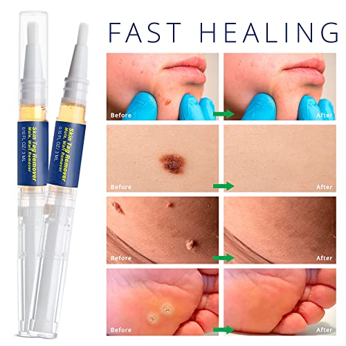 Skin Tag Remover, Advanced New Wart Remover, Quickly, Safe and Gentle, Suitab...