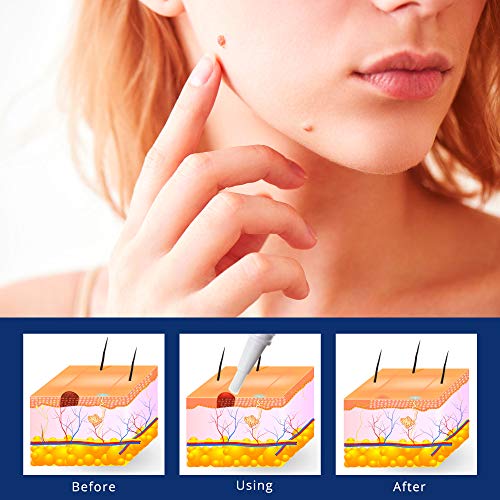 Skin Tag Remover, Advanced New Wart Remover, Quickly, Safe and Gentle, Suitab...