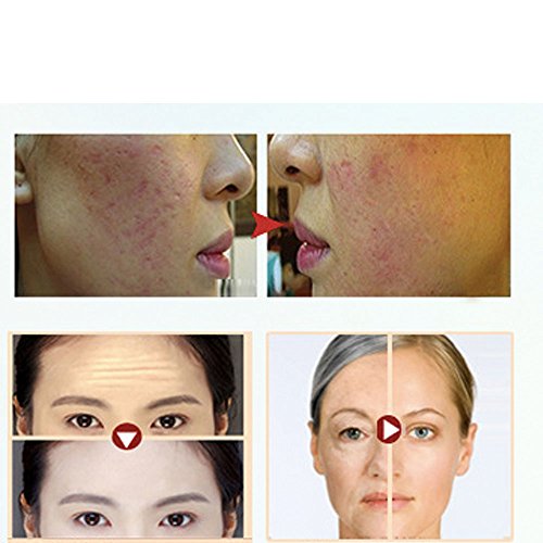 Acne Wrinkle Anti-Aging Exfoliating Skin Health Care Massage Relaxation Devic...