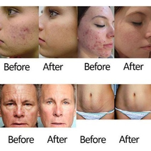 Acne Wrinkle Anti-Aging Exfoliating Skin Health Care Massage Relaxation Devic...