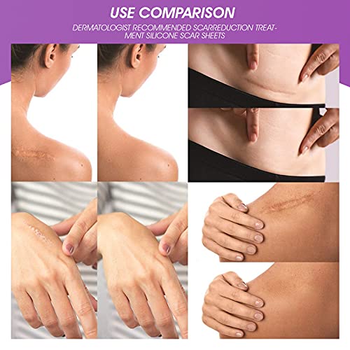 Silicone Scar Sheets, Professional Medical-Grade Scar Removal Sheets for C-Se...