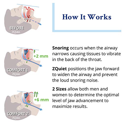 ZQuiet Anti-Snoring Mouthpiece Solution - Introductory Starter Kit (Two Sizes...